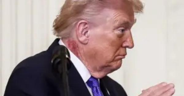 Παγκόσμια Ανησυχία για την υγεία του Ντόναλντ Τραμπ – Τι σημαίνει το εξάνθημα που έχει στο λαιμό του