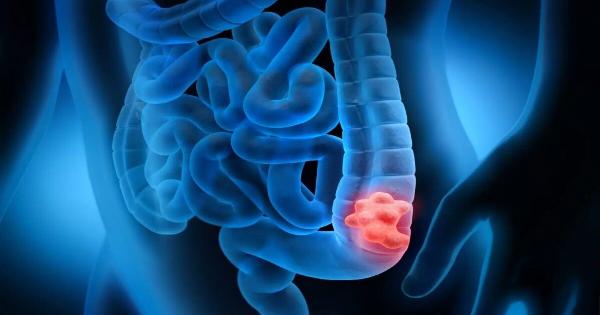 Σημάδια καρκίνου του παχέος εντέρου: Τα συμπτώματα που δεν πρέπει να αγνοήσετε