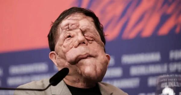 Xαμoς στα Όσκαρ: Πασίγνωστος ηθοποιός εμφανίστηκε με Auτo το πρόσωπο και… πάγωσαv όλοι – Η σπάνια Appώστια που τον «xτuπnσε»