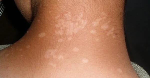 Γιατί εμφανίζονται μικρές λευκές κηλίδες στο δέρμα σας